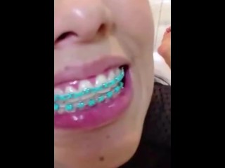 Hottest braceface