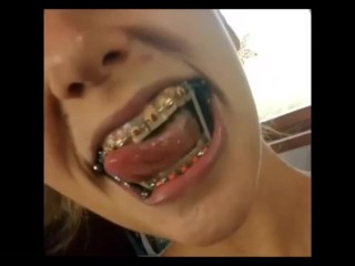 Sexy braces Herbst and elastics close up