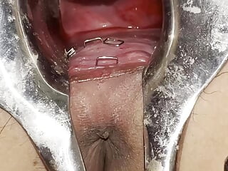 Urethral stapler