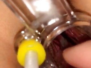 cervix  Insertion stick play
